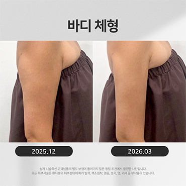비만/체형 시술전후