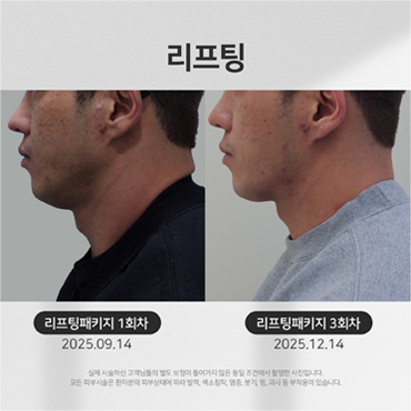 리프팅 시술전후