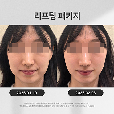 리프팅 시술전후