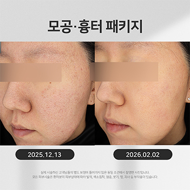 모공흉터 시술전후