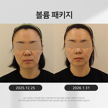 볼륨 시술전후