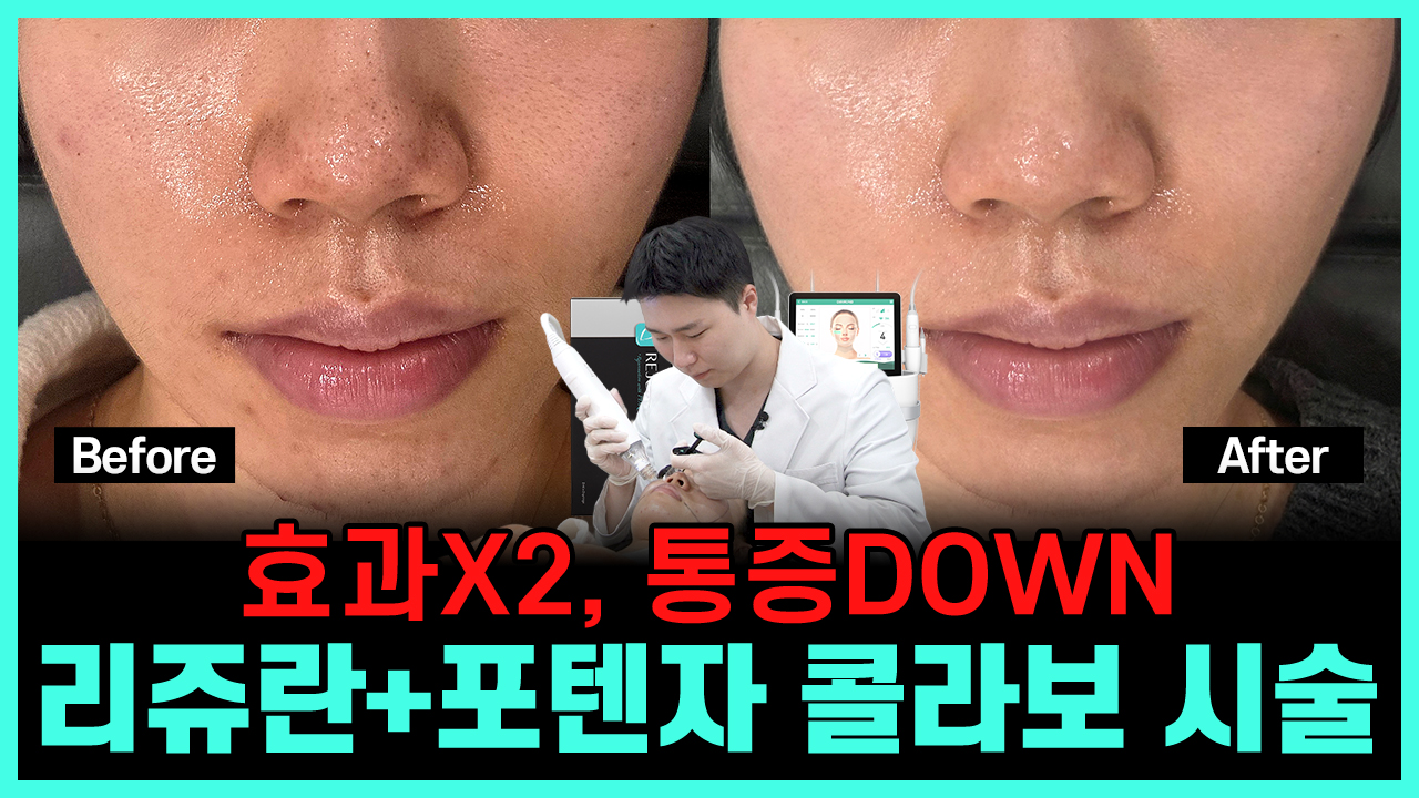 의정부 포텐자 리쥬란 모공관리