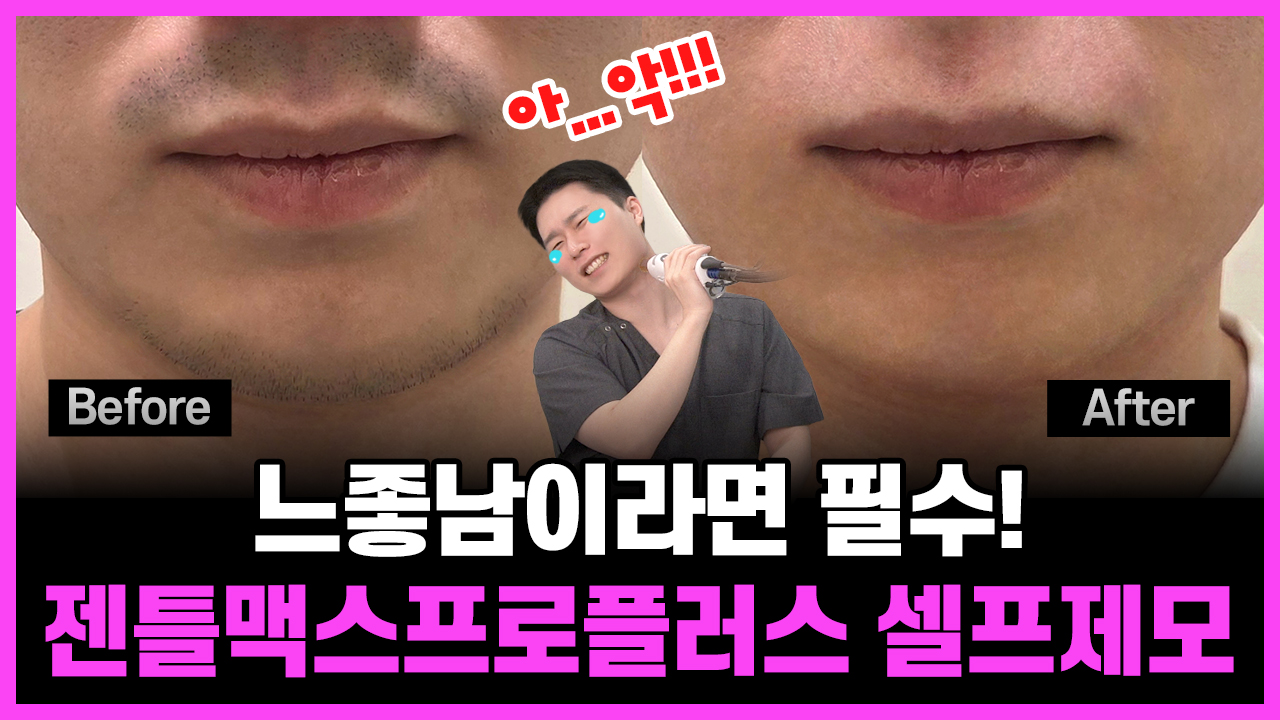 의정부 남자 수염제모 젠틀맥스프로플러스 후기
