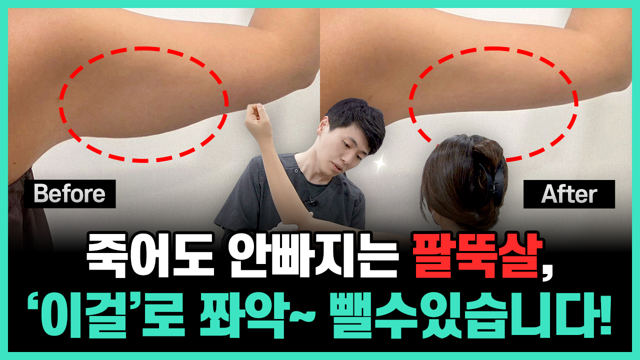 의정부 바디온다 팔뚝살 지방분해주사